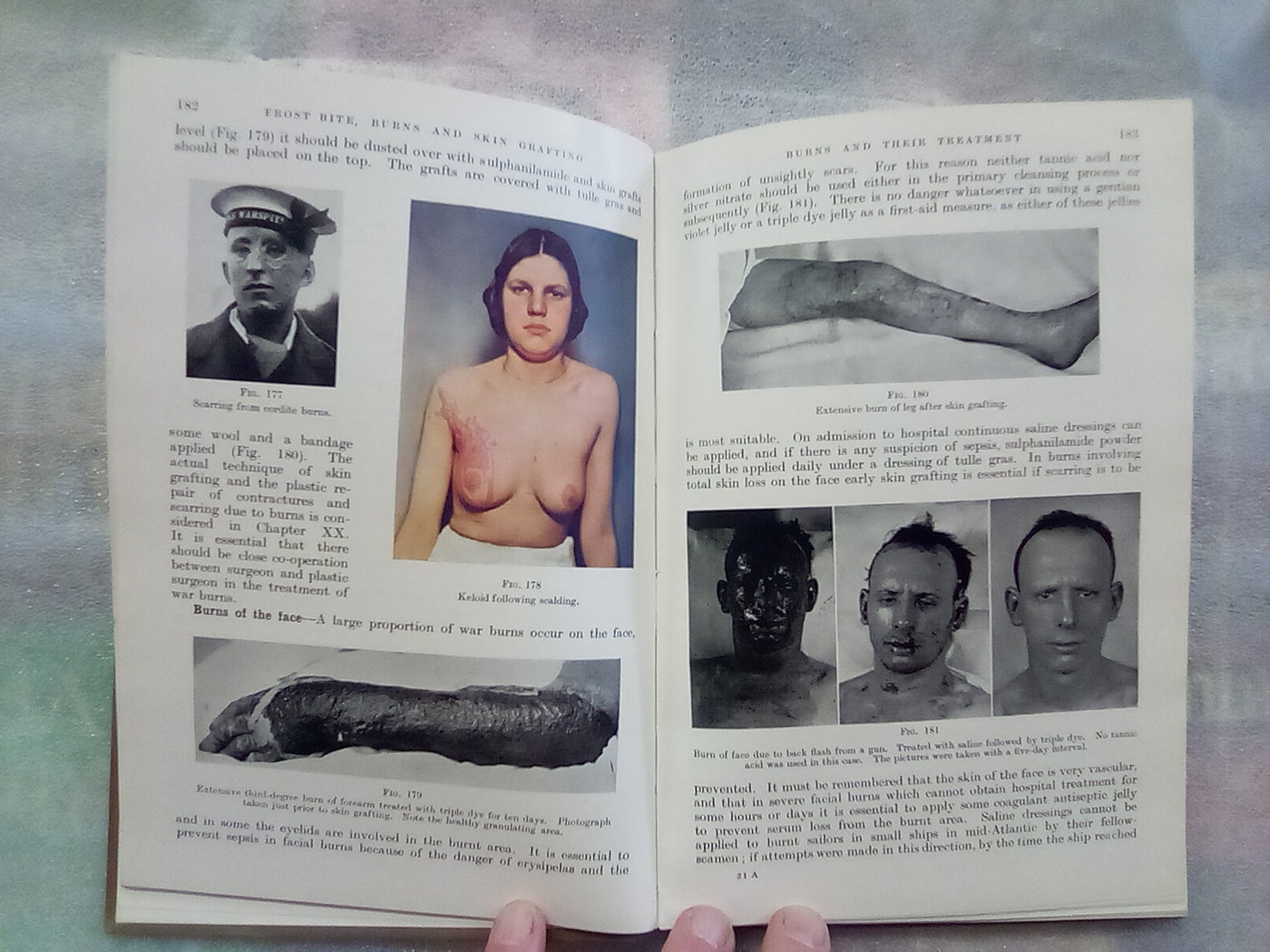 Surgery of Modern Warfare - Third Edition - 6 Volume Set (1944)