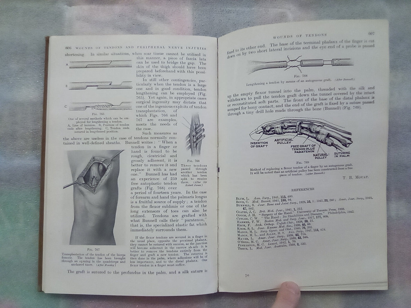 Surgery of Modern Warfare - Third Edition - 6 Volume Set (1944)